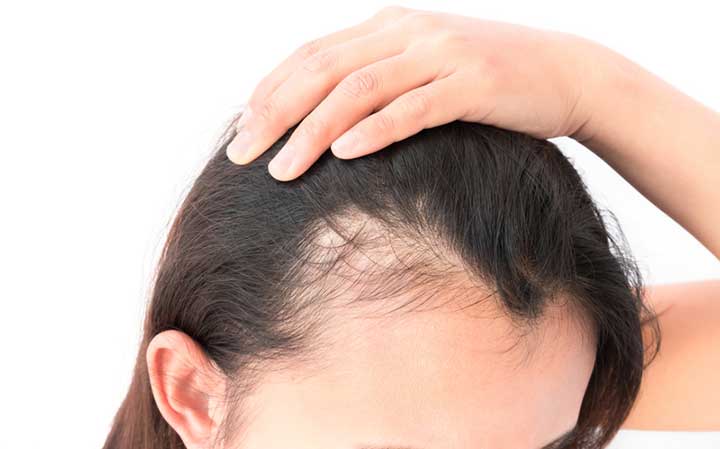 Women hair loss